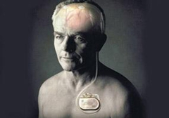 起搏器真的能治好帕金森病嗎？