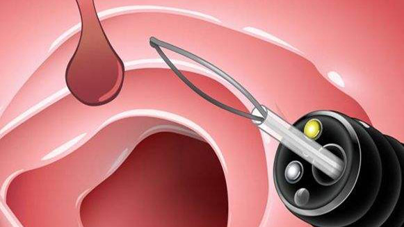 【健康解碼&middot;小貼士】檢查出息肉 需要切除嗎？